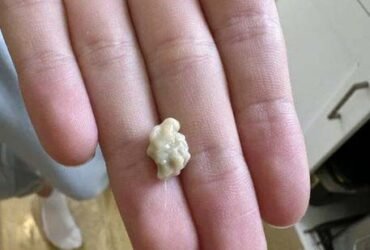 tout ce que vous devez savoir sur les calculs amygdaliens